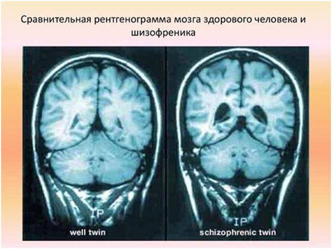 Сравнительная рентгенограмма мозка здорового человека и шизофреника